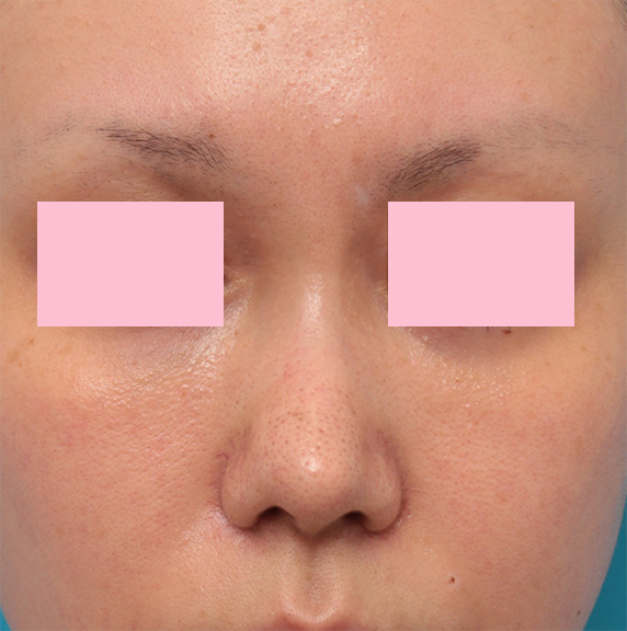 他院で受けた手術の修正（鼻）,他院で鼻に注入されたアクアミドらしき物を手術で除去した症例写真の術前術後画像,After（3ヶ月後）,ba_modify06_a01.jpg