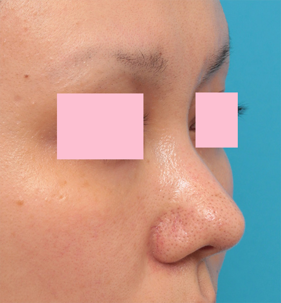 他院で受けた手術の修正（鼻）,他院で鼻に注入されたアクアミドらしき物を手術で除去した症例写真の術前術後画像,After（3ヶ月後）,ba_modify07_b.jpg