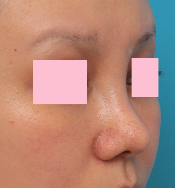 他院で受けた手術の修正（鼻）,他院で鼻に注入されたアクアミドらしき物を手術で除去した症例写真の術前術後画像,Before,ba_modify07_b.jpg