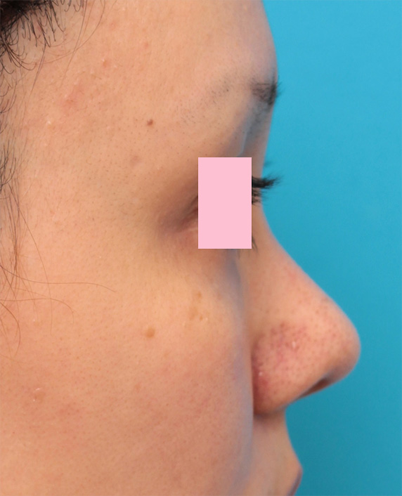症例写真,他院で鼻に注入されたアクアミドらしき物を手術で除去した症例写真の術前術後画像,After（3ヶ月後）,ba_modify08_b.jpg