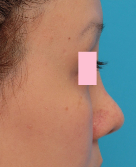 他院で受けた手術の修正（鼻）,他院で鼻に注入されたアクアミドらしき物を手術で除去した症例写真の術前術後画像,Before,ba_modify08_b.jpg