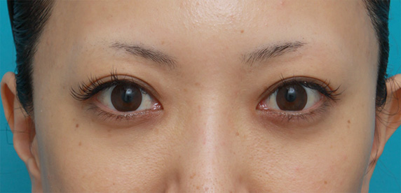 ヒアルロン酸分解・溶解（ヒアルロニダーゼ注射）,他院で目の下に質の悪いヒアルロン酸を注射され凸凹になり、ヒアルロニダーゼで改善させた症例写真,After（1ヶ月後）,ba_hyaluronjyokyo05_b.jpg