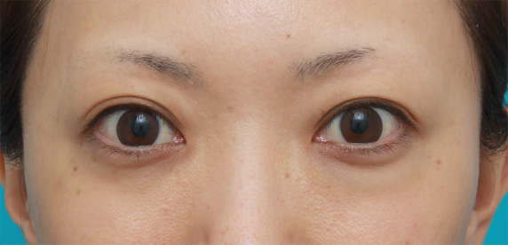 他院で受けた手術の修正（二重まぶた・目もと）,他院で目の下に質の悪いヒアルロン酸を注射され凸凹になり、ヒアルロニダーゼで改善させた症例写真,Before,ba_hyaluronjyokyo05_b.jpg