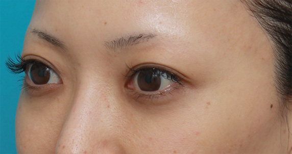 ヒアルロン酸分解・溶解（ヒアルロニダーゼ注射）,他院で目の下に質の悪いヒアルロン酸を注射され凸凹になり、ヒアルロニダーゼで改善させた症例写真,After（1ヶ月後）,ba_hyaluronjyokyo06_b.jpg