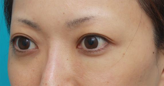 ヒアルロン酸分解・溶解（ヒアルロニダーゼ注射）,他院で目の下に質の悪いヒアルロン酸を注射され凸凹になり、ヒアルロニダーゼで改善させた症例写真,Before,ba_hyaluronjyokyo06_b.jpg