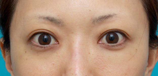 他院で受けた手術の修正（二重まぶた・目もと）,他院で目の下に質の悪いヒアルロン酸を注射され凸凹になり、ヒアルロニダーゼで改善させた症例写真,注射直後,mainpic_hyaluronjyokyo03b.jpg