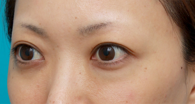 ヒアルロン酸分解・溶解（ヒアルロニダーゼ注射）,他院で目の下に質の悪いヒアルロン酸を注射され凸凹になり、ヒアルロニダーゼで改善させた症例写真,注射前,mainpic_hyaluronjyokyo03d.jpg