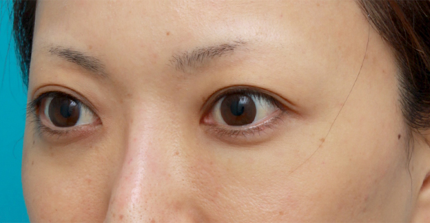 ヒアルロン酸分解・溶解（ヒアルロニダーゼ注射）,他院で目の下に質の悪いヒアルロン酸を注射され凸凹になり、ヒアルロニダーゼで改善させた症例写真,注射直後,mainpic_hyaluronjyokyo03e.jpg