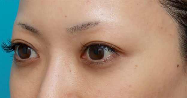 ヒアルロン酸分解・溶解（ヒアルロニダーゼ注射）,他院で目の下に質の悪いヒアルロン酸を注射され凸凹になり、ヒアルロニダーゼで改善させた症例写真,1ヶ月後,mainpic_hyaluronjyokyo03f.jpg