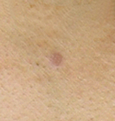 症例写真,CO2レーザーで襟足のほくろを除去した症例写真,1週間後,mainpic_hokuro_ibo_aza02c.jpg