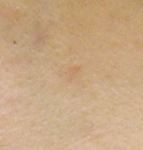 症例写真,CO2レーザーで襟足のほくろを除去した症例写真,3ヶ月後,mainpic_hokuro_ibo_aza02d.jpg