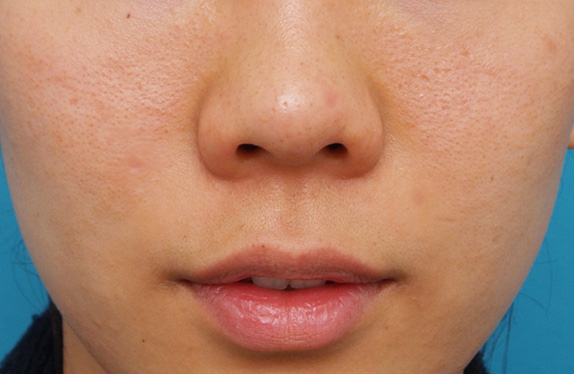 CO2レーザーで鼻の頭のほくろを除去した症例写真,After（3ヶ月後）,ba_hokuro_ibo_aza_pic10_a01.jpg