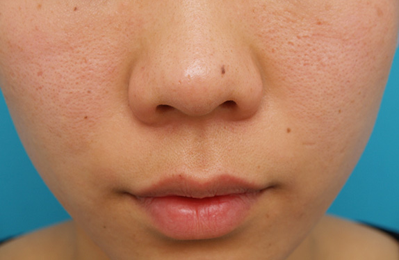 CO2レーザー,CO2レーザーで鼻の頭のほくろを除去した症例写真,Before,ba_hokuro_ibo_aza_pic10_b.jpg