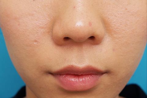 症例写真,CO2レーザーで鼻の頭のほくろを除去した症例写真,1週間後,mainpic_hokuro_ibo_aza03c.jpg