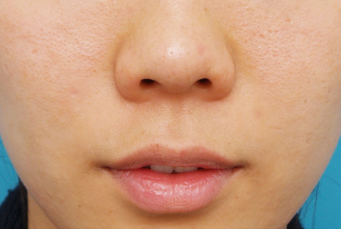 CO2レーザー,CO2レーザーで鼻の頭のほくろを除去した症例写真,3ヶ月後,mainpic_hokuro_ibo_aza03d.jpg