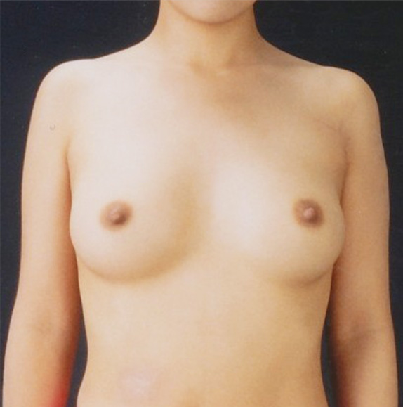 豊胸手術（シリコンプロテーゼ）,豊胸手術（シリコンプロテーゼ）の症例写真 乳腺下に220CCずつ挿入,After,ba_hokyo29_b.jpg