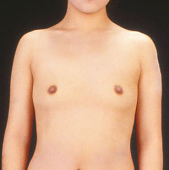 豊胸手術（シリコンプロテーゼ）,豊胸手術（シリコンプロテーゼ）の症例写真 乳腺下に220CCずつ挿入,Before,ba_hokyo29_b.jpg