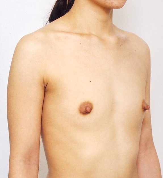 症例写真,豊胸手術（シリコンプロテーゼ）の症例 左右それぞれ200CCの挿入,Before,ba_hokyo27_b.jpg