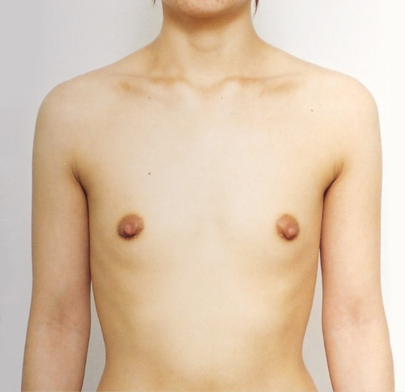 豊胸手術（シリコンプロテーゼ）,豊胸手術（シリコンプロテーゼ）の症例 左右それぞれ200CCの挿入,Before,ba_hokyo28_b.jpg