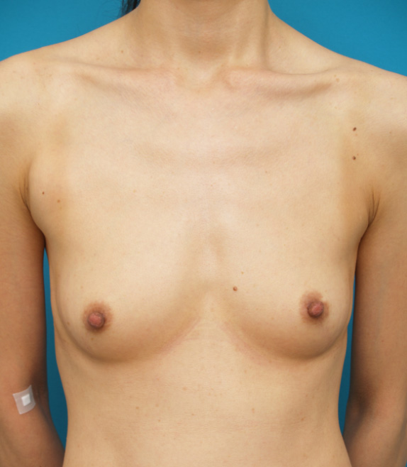 胸の上のほうの張りを出すために、大胸筋下にシリコンプロテーゼ豊胸手術した症例　150CCずつ挿入,Before,ba_hokyo23_b.jpg