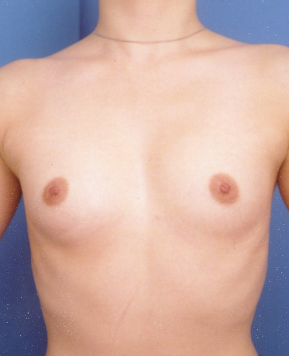 症例写真,豊胸手術（シリコンプロテーゼ）の症例 10代の頃から巨乳願望が強かった患者様,Before,ba_hokyo34_b.jpg