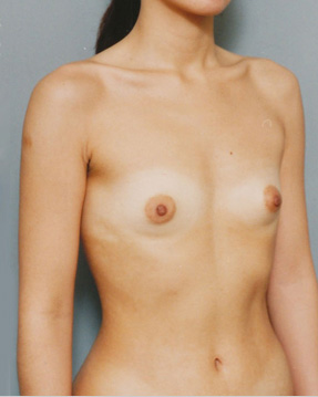 豊胸手術（シリコンプロテーゼ）,豊胸手術（シリコンプロテーゼ）の症例 乳腺下に240CCずつ挿入,Before,ba_hokyo32_b.jpg