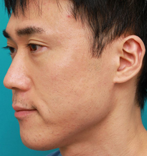 しみ・あざ取りレーザー,顔の盛り上がったシミ（セボケラ、脂漏性角化症）をCO2レーザーアブレージョンで治療した症例写真,After（6ヶ月後）,ba_hokuro_ibo_aza23_b.jpg