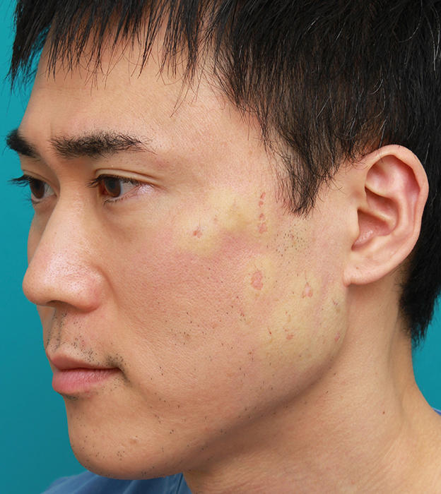 しみ・あざ取りレーザー,顔の盛り上がったシミ（セボケラ、脂漏性角化症）をCO2レーザーアブレージョンで治療した症例写真,治療直後,mainpic_hokuro_ibo_aza06b.jpg
