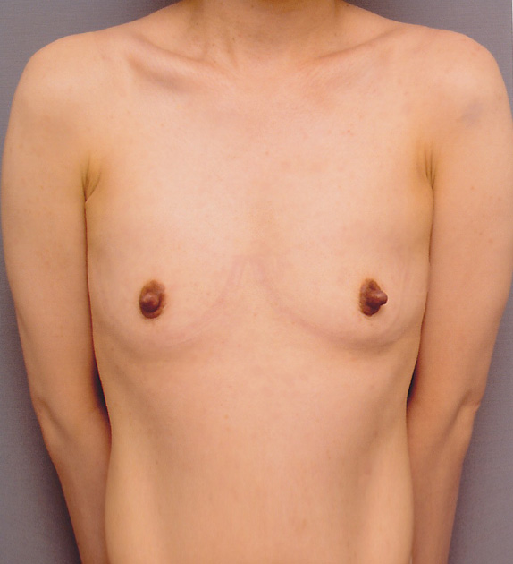 豊胸手術（シリコンプロテーゼ）,豊胸手術（シリコンプロテーゼ）の症例 大胸筋下に150CCずつ挿入,Before,ba_hokyo22_b.jpg