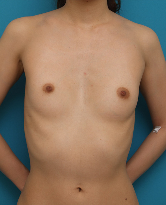 豊胸手術（シリコンプロテーゼ）,軽度の漏斗胸によるバストの非対称に対して、豊胸手術で修正した症例写真　右に150cc、左に125cc,Before,ba_hokyo41_b.jpg