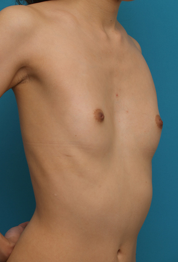 豊胸手術（シリコンプロテーゼ）,軽度の漏斗胸によるバストの非対称に対して、豊胸手術で修正した症例写真　右に150cc、左に125cc,Before,ba_hokyo42_b.jpg