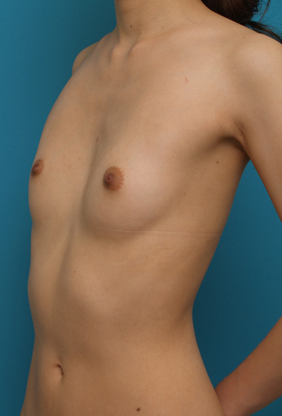 豊胸手術（シリコンプロテーゼ）,軽度の漏斗胸によるバストの非対称に対して、豊胸手術で修正した症例写真　右に150cc、左に125cc,Before,ba_hokyo43_b.jpg