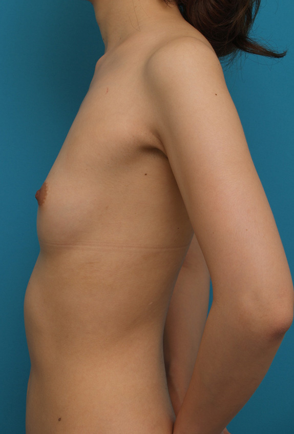 豊胸手術（シリコンプロテーゼ）,軽度の漏斗胸によるバストの非対称に対して、豊胸手術で修正した症例写真　右に150cc、左に125cc,Before,ba_hokyo44_b.jpg