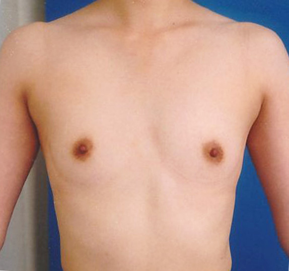 豊胸手術（シリコンプロテーゼ）,豊胸手術（シリコンプロテーゼ）の症例 大胸筋下に125CCずつ挿入,Before,ba_hokyo40_b.jpg