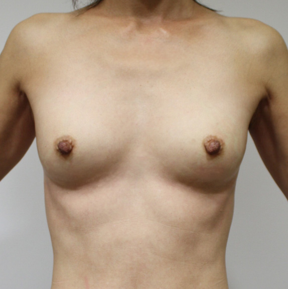 豊胸手術（シリコンプロテーゼ）,豊胸手術（シリコンプロテーゼ）の症例 大胸筋下に100ccずつ挿入,After,ba_hokyo17_b.jpg