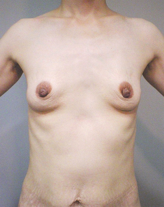 豊胸手術（シリコンプロテーゼ）,授乳後の萎んで垂れたバストに乳腺下100ccのシリコンプロテーゼで豊胸手術した症例写真,Before,ba_hokyo51_b.jpg