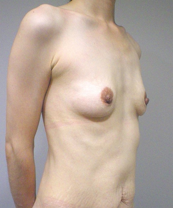 豊胸手術（シリコンプロテーゼ）,授乳後の萎んで垂れたバストに乳腺下100ccのシリコンプロテーゼで豊胸手術した症例写真,Before,ba_hokyo52_b.jpg