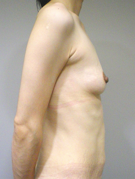 豊胸手術（シリコンプロテーゼ）,授乳後の萎んで垂れたバストに乳腺下100ccのシリコンプロテーゼで豊胸手術した症例写真,Before,ba_hokyo53_b.jpg