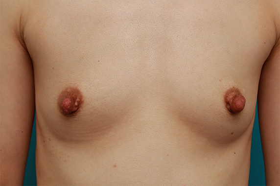 豊胸手術（シリコンプロテーゼ）,豊胸手術と乳頭縮小手術を同時に行い、バランスのとれた自然な美乳を作った症例写真　左右125ccずつ,Before,ba_hokyo64_b.jpg