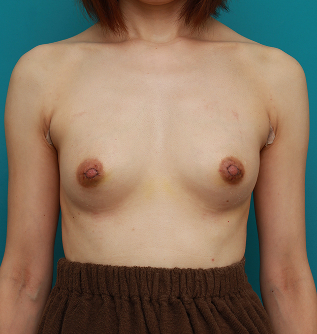 豊胸手術（シリコンプロテーゼ）,豊胸手術と乳頭縮小手術を同時に行い、バランスのとれた自然な美乳を作った症例写真　左右125ccずつ,1週間後,mainpic_hokyo02c.jpg