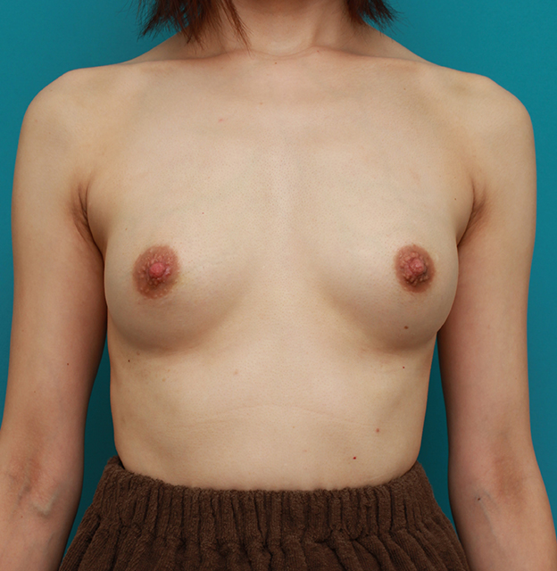 乳頭縮小,豊胸手術と乳頭縮小手術を同時に行い、バランスのとれた自然な美乳を作った症例写真　左右125ccずつ,2週間後,mainpic_hokyo02d.jpg