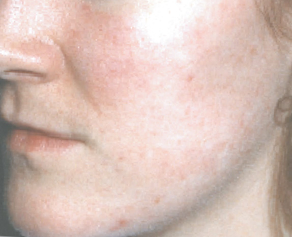 フォトフェイシャルM22,フォトフェイシャルM22の症例　赤ら顔の治療,After,ba_iplphoto_pic12_a01.jpg