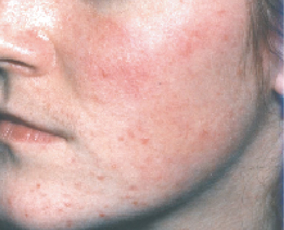 フォトフェイシャルM22,フォトフェイシャルM22の症例　赤ら顔の治療,Before,ba_iplphoto_pic12_b.jpg