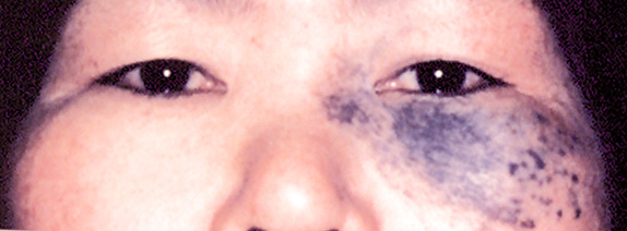 レーザー（しみ・あざ）の症例　太田母斑を治療,Before,ba_shimi_pic08_b.jpg