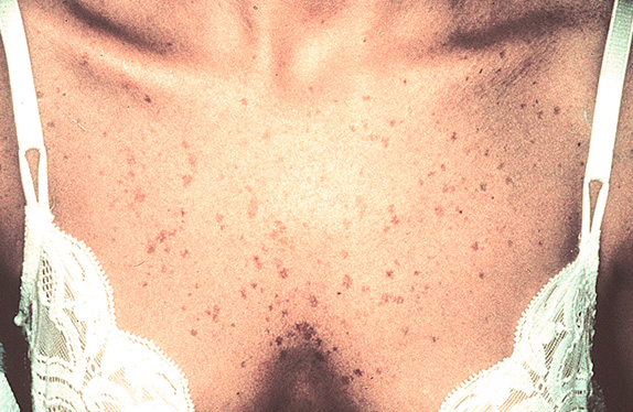 レーザー（しみ・あざ）の症例　胸部シミを治療,Before,ba_shimi_pic07_b.jpg