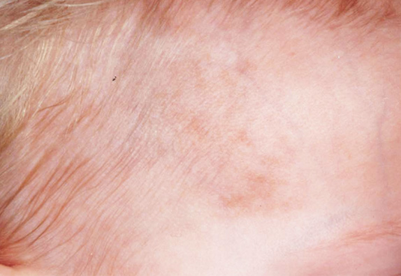 レーザー（しみ・あざ）の症例　扁平母斑を治療,After,ba_shimi_pic06_a01.jpg