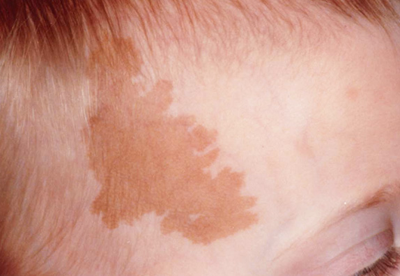 レーザー（しみ・あざ）の症例　扁平母斑を治療,Before,ba_shimi_pic06_b.jpg