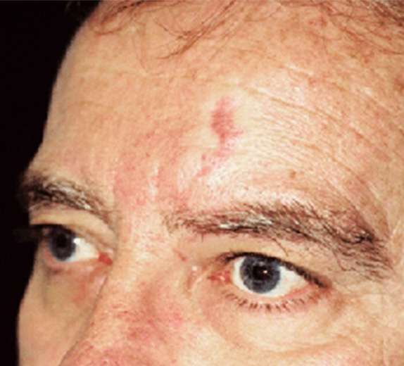 Vビーム,Vビームの症例写真 赤く盛り上がった額の血管腫を治療,After,ba_vbeam_laser_pic29_a01.jpg