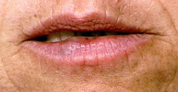 Vビーム,Vビームの症例写真　唇血管腫を治療,After,ba_vbeam_laser_pic25_b.jpg