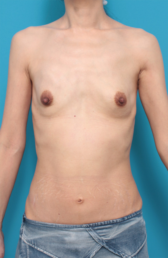 マンマリーヒアル（R）（プチ豊胸術・ヒアルロン酸豊胸術）,マンマリーヒアル(R)（プチ豊胸術・ヒアルロン酸豊胸術）の症例 元々体型がスリムな女性,After,ba_mammary49_b.jpg